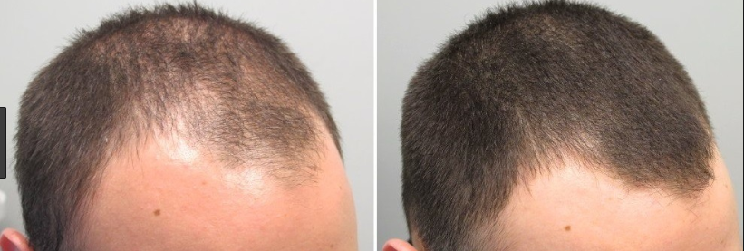 Minoxidil Hair Loss Solution 5 For Men Better Your Hair Medium