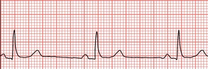 Do You Have Free Style Ecg 在本篇文章中會將論文常用到的幾個症狀寫出來並且圖文介紹 By 黃馨平 Jackycsie Medium