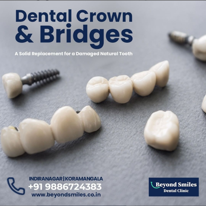 Cheap and best dentist in Indiranagar | by Beyondsmiles Indiranagar | Aug, 2022 | Medium