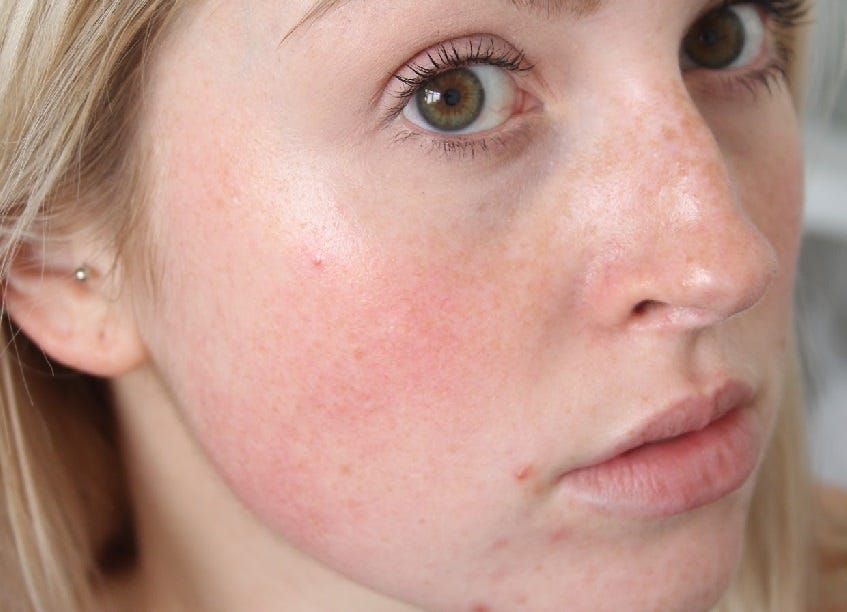 facial blemishes