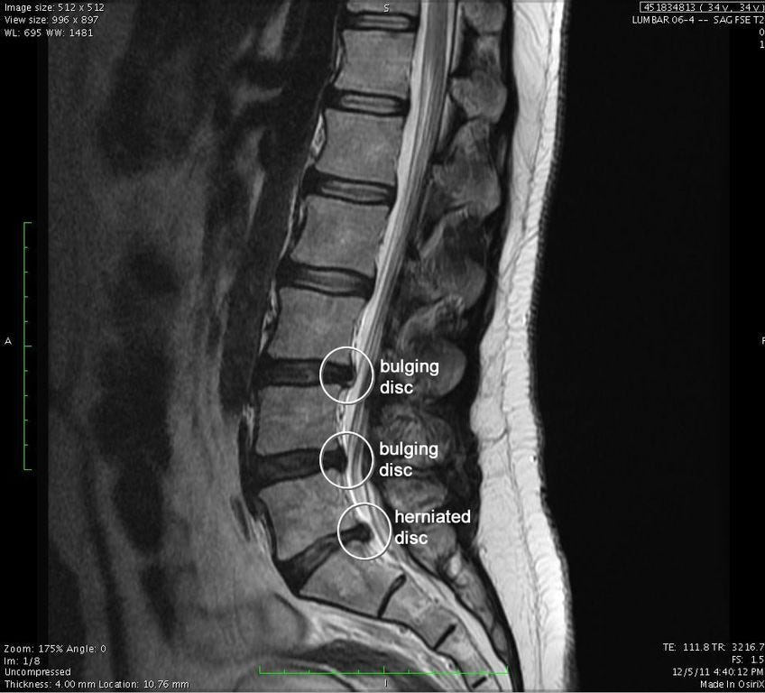 how to read mri images of lumbar spine