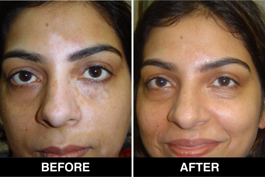 How to find Vitiligo Specialist & White Patches Treatment in Delhi | by Skin  Laser Centre | Medium