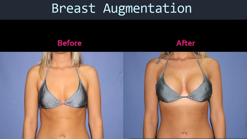 a breast augmentaion Solo chubby pussy vids