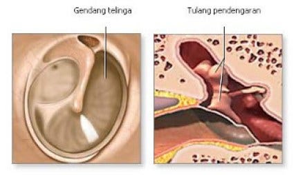 Unduh 920 Gambar Gendang Telinga Yang Bolong  