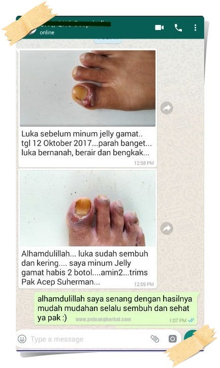 mengobati cantengan  jempol kaki secara alami