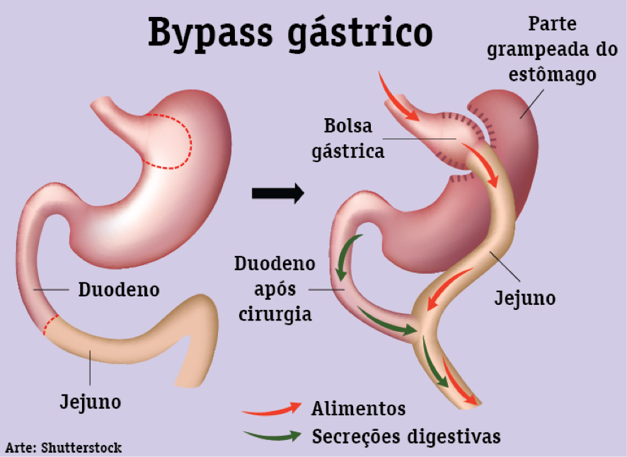 Bypass gastrico dieta postoperatoria