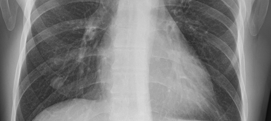 Evaluating Chest X Rays Using Ai In Your Browser Testing Chester By Balint Botz Medium