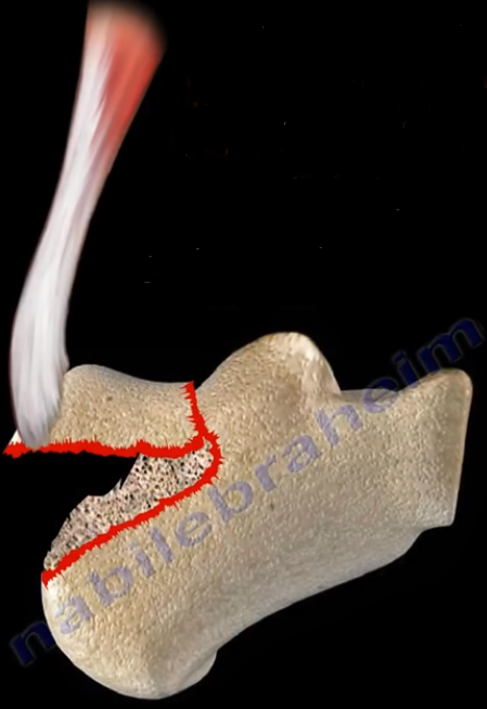 Calcaneal Fracture - Nabil Ebraheim - Medium