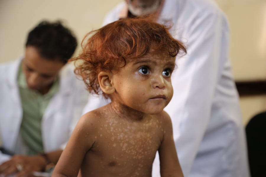 夕食とれずに眠る子どもたち イエメン 紛争が生む貧困 飢餓 病気 By Wfp日本 レポート Medium