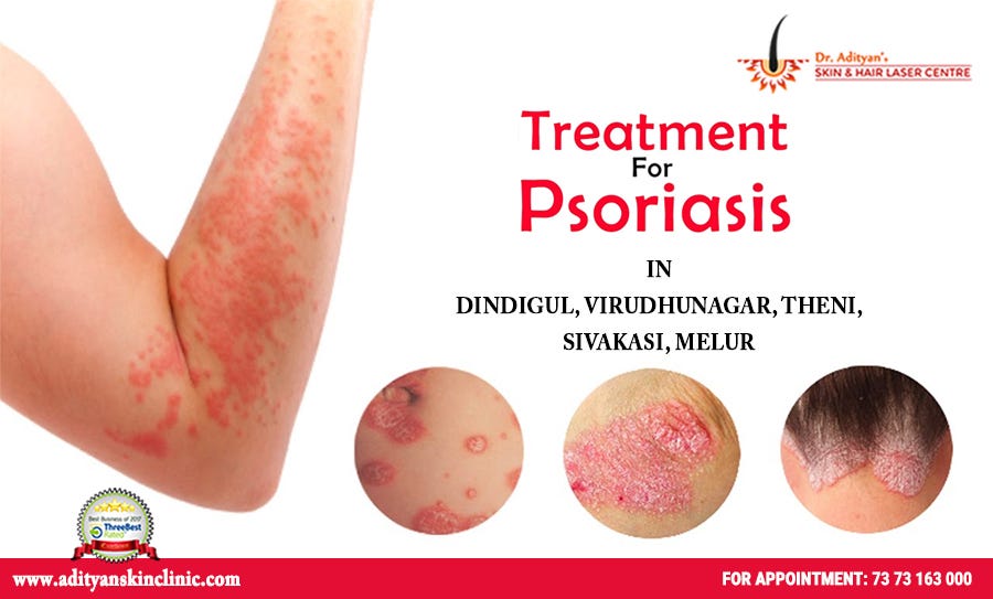 psoriasis flare up