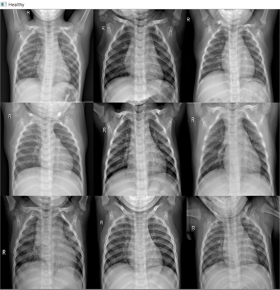 Build a  App to detect Pneumonia from Chest XRay Images Part 1