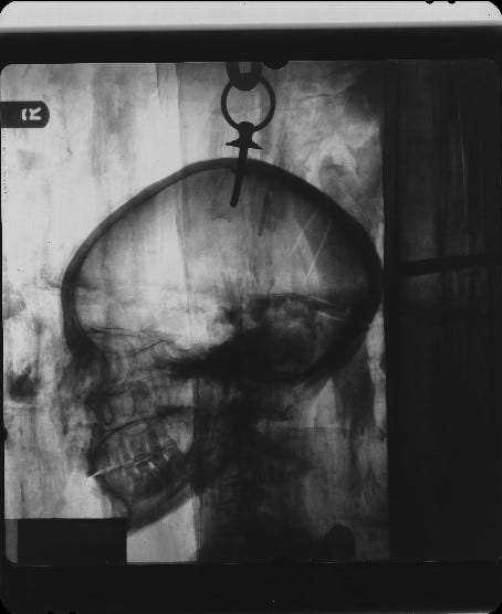 X-ray of a human skull with a hook attached to the top of the cranium.