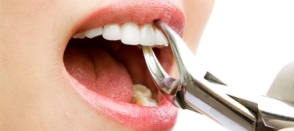 Important facts to know regarding tooth extraction Las Vegas | by Preferred  Dentistry | Medium