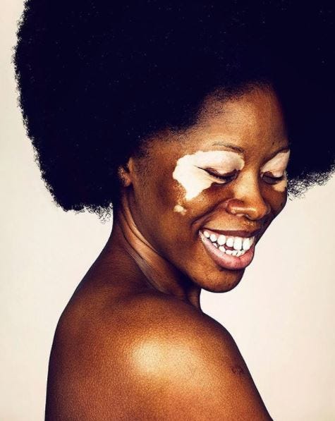 8-girls-with-vitiligo-bare-all-in-brock-elbank-photo-shoot-see