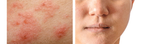 Eczema On The Face Your Skincare Routine By Kurt Lohmann Medium
