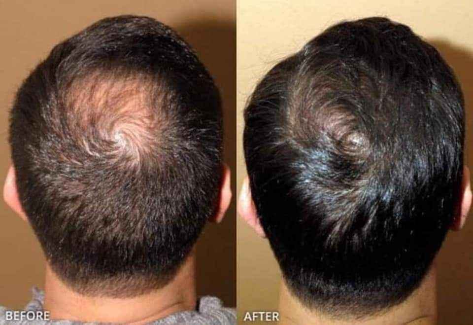 This is How You Can Stop Hair Loss And Grow More Hair Easily. by