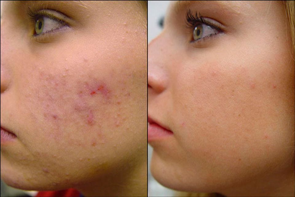 Acne Treatment Scar Removal How Much?