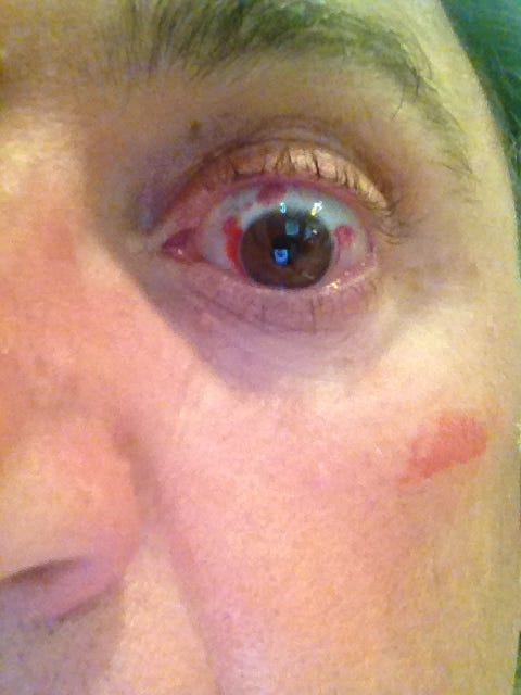 Picture of eyes the day after surgery.