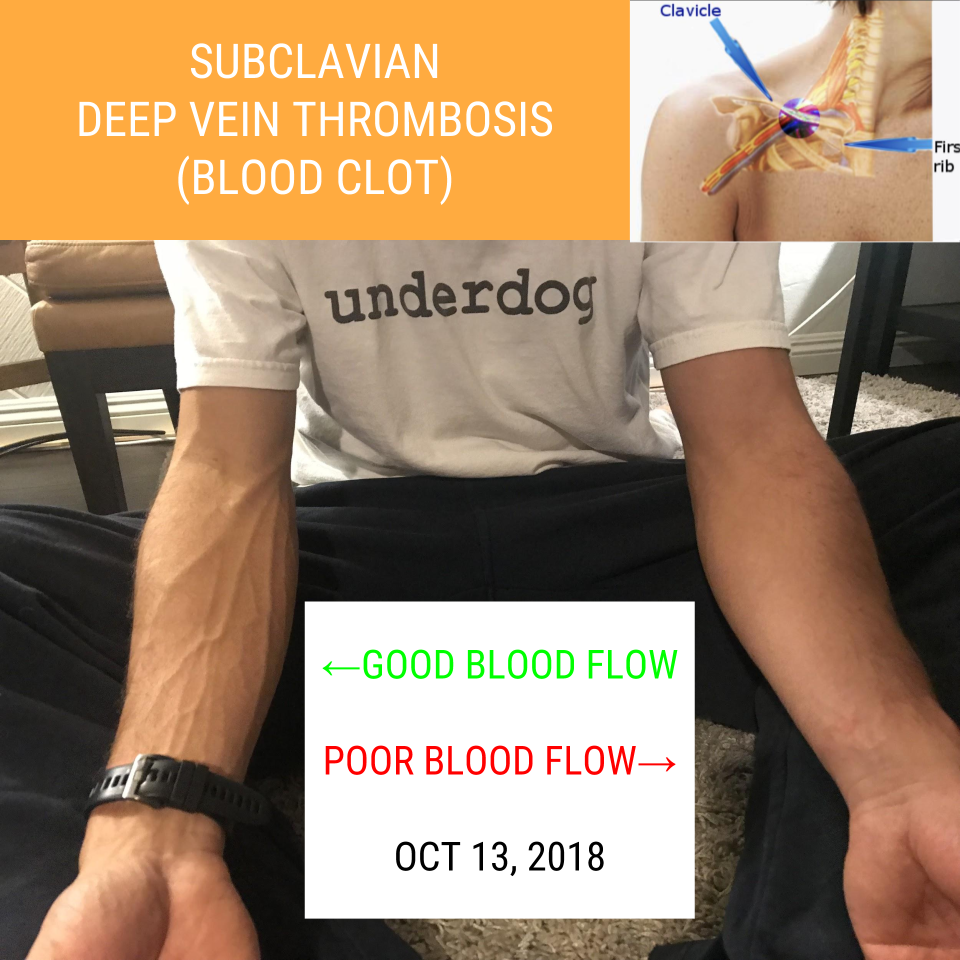 My September 2018 Blood Clot Injury By Mickey Ferri Medium
