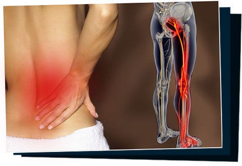 6 Sciatica Cure Success Stories Click Here To Read Others Sciatica By Share Ev Medium