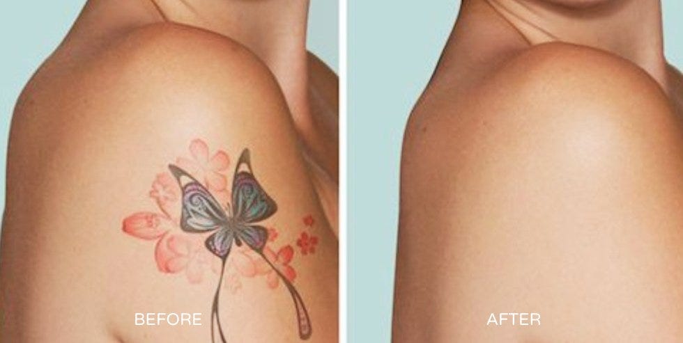 Laser Tattoo Removal Process All You Need To Know By Premium Tattoo Removal Medium