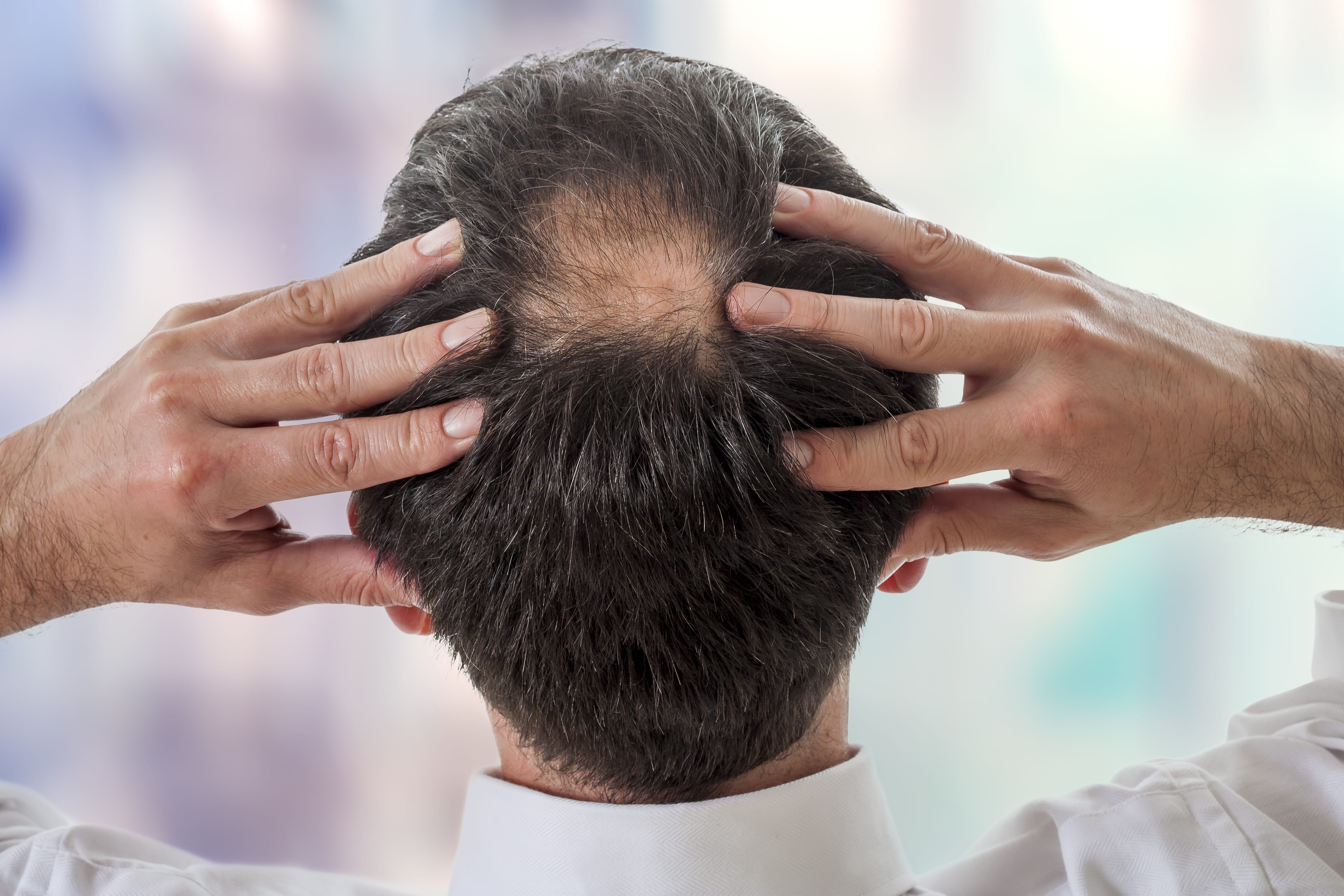 Restoring Hair When Nothing Else Works Dr U Hair And Skin Medium