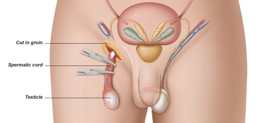 I Got An Orchiectomy, Here's What It Was Like - Lacey Artemis - Medium
