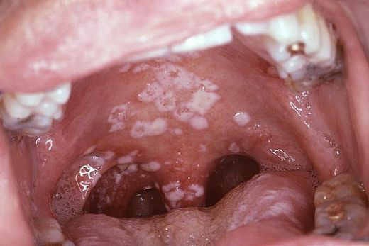 manuskript lede efter Ja 8 Causes of White Spots On Tonsils That You Need to Know | by Sanjeev Kumar  | Medium