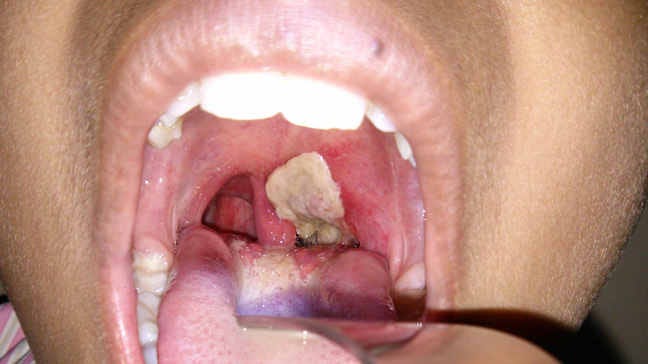 8 Causes of White Spots On Tonsils That You Need to Know | by Sanjeev Kumar  | Medium