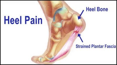 heel pain therapy