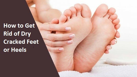 How To Get Rid Of Dry Cracked Feet Or Heels By How2world Medium