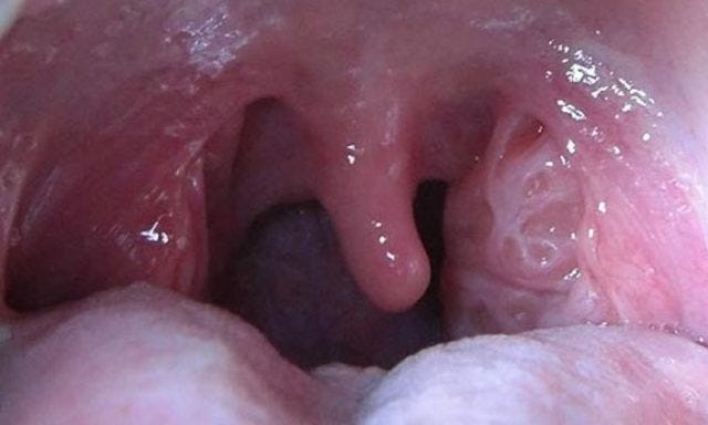 Tonsils