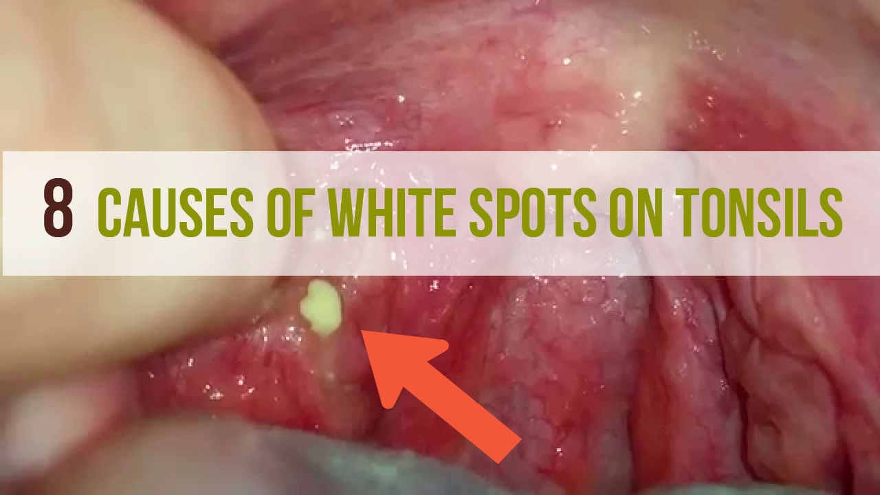 8 Causes of White Spots On Tonsils That You Need to Know | by Sanjeev Kumar  | Medium