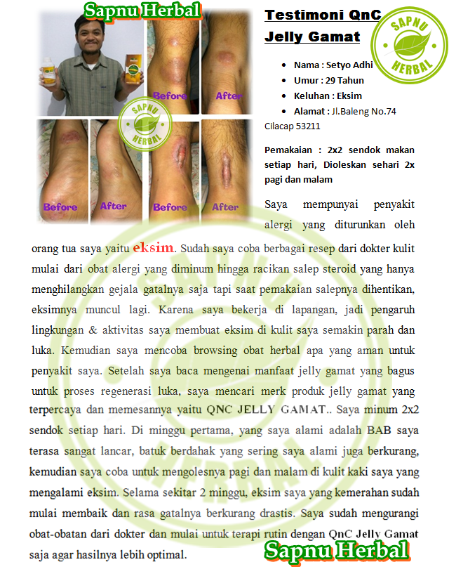 Image result for qnc untuk keloid