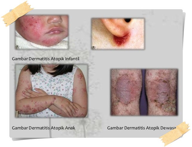 Image result for dermatitis atopik