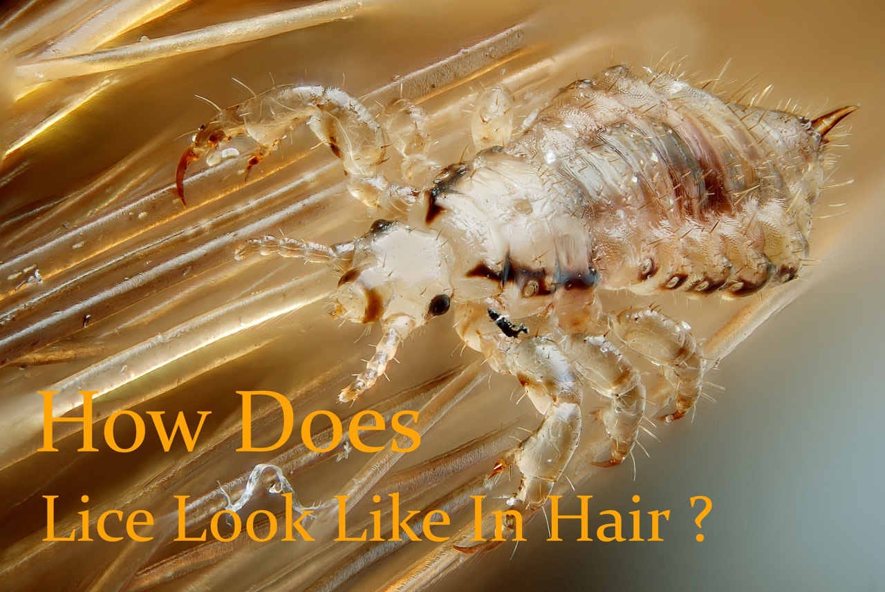 A Quick Guide To Lice In Hair To Be Your Own Liceender By Sanjeev Kumar Medium