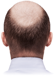 How To Regrow Hairline Naturally Donna Jenkins Medium