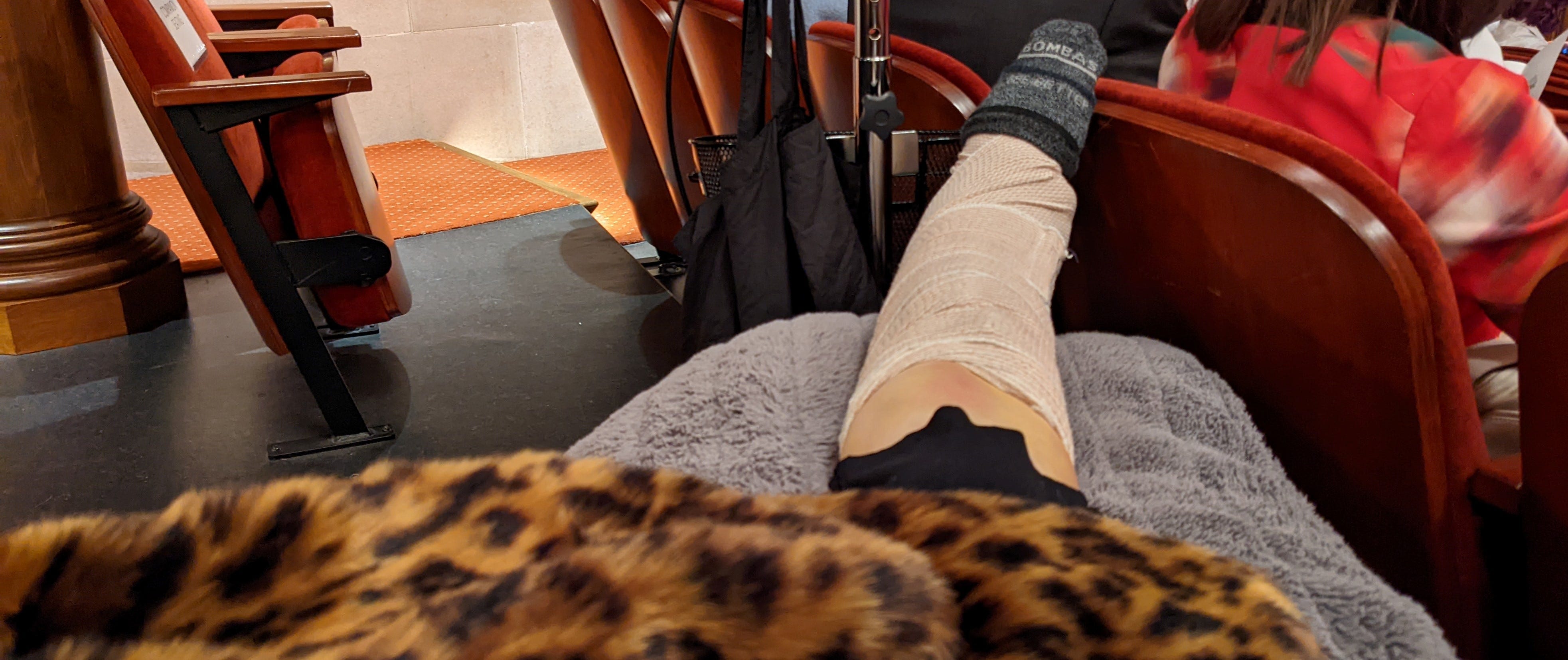 Splinted lower leg resting on pillow on knee scooter to keep badly broken ankle elevated