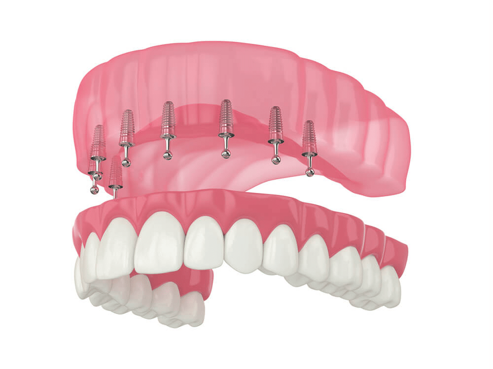 Everything You Need to Know About Snap-On Dentures