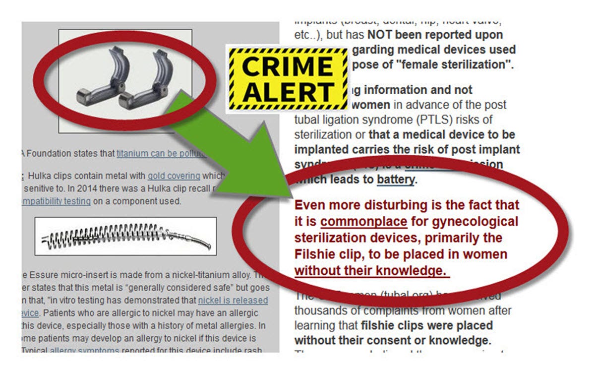 begroting Verbetering ziekte Filshie Clips, “Post Implant Syndrome” and Crimes of Medical Battery | by  Susan Bucher, BSN | Medium