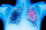 How deadly is lung cancer? Signs, symptoms, and prevention, according to an expert