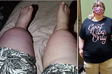 Doctors Told Me I Was ‘Just Fat’ — My Serious Medical Condition Was Missed