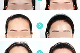 Everything You Need to Know About Forehead Reduction Surgery