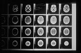 brain mri images