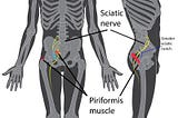 When is Sciatica, not Sciatica? By Dr. Steven Zodkoy