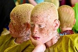 Albinism: An Exploration into My Humanity.