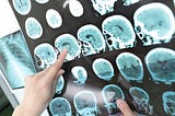 Re-Thinking The ‘When’ And ‘How’ Of Brain Death