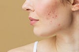 Understanding Acne