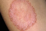 How do I get rid of fungal infection?