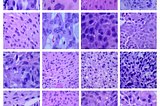 Transfer learning for efficient classification in lung cancer detection using mobilenet…